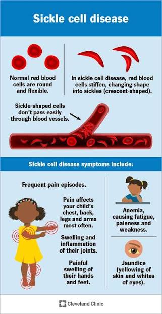 Coping With Sickle Cell Disease: What It Is And What Treatment Looks Like In 2026