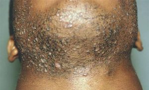 Razor Bumps And Ingrown Hairs: How To Quickly Treat And Get Rid Of Them